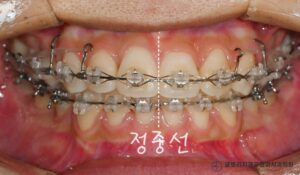 Read more about the article 망우동 치과 정중선 편위 및 삐뚤어진 치열, 가지런한 배열을 회복하기 위한 발치 교정