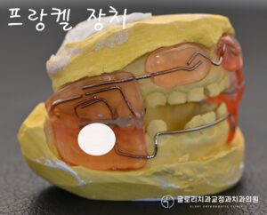 Read more about the article 양원역 교정치과 성장기 어린이 반대교합: 프랑켈 장치를 통한 1차교정