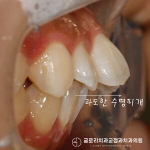 Read more about the article 망우역 치과 뻗쳐있는 앞니, 돌출입 개선에 필요한 발치교정에 대해 알아보자.