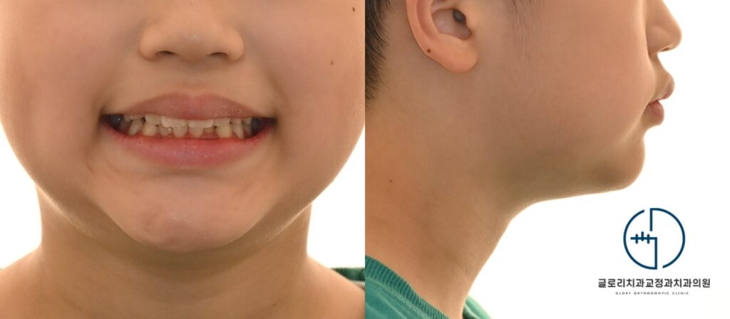 중랑구 교정치과 성장기 교정의 중요성: 비발치 교정을 통한 총생 개선
