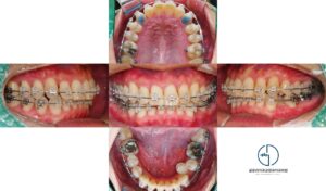 Read more about the article 양원역 교정치과 깊게 물리는 과개교합과 심한 총생, 비발치 교정으로 개선할 수 있을까?
