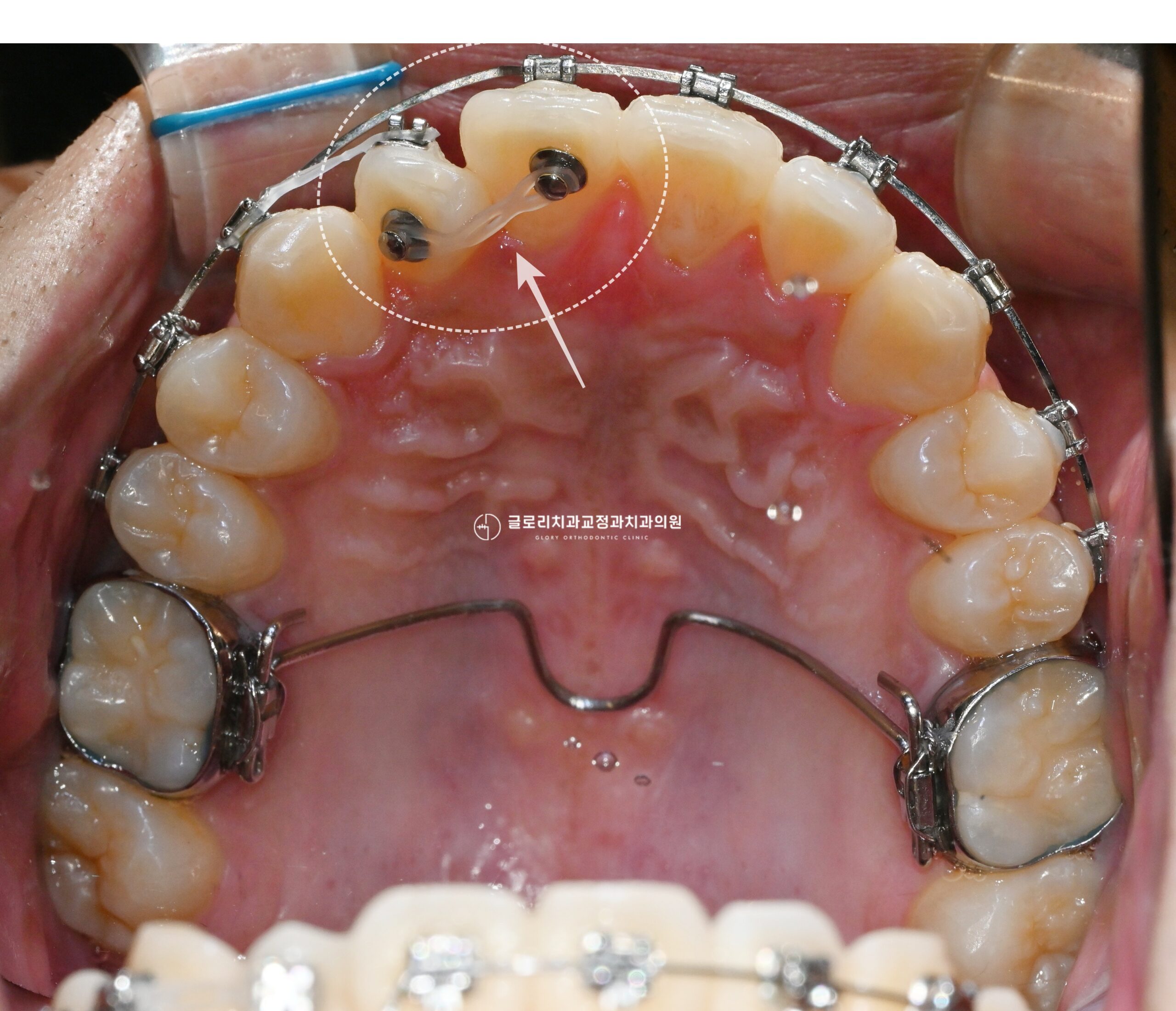 You are currently viewing 상봉동 교정치과 총생과 정중선 편위, 상악골 확장장치를 동반한 비발치 교정