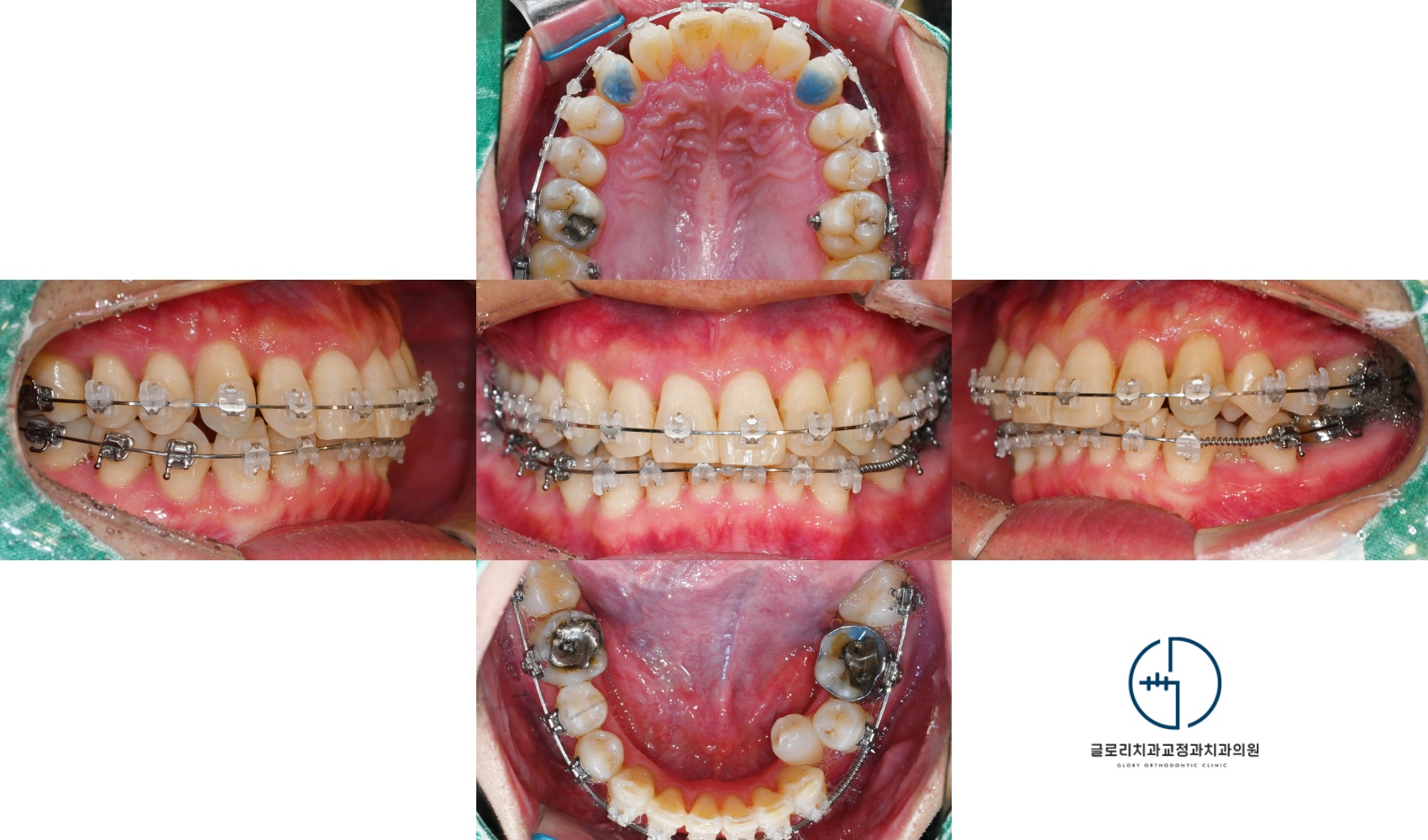You are currently viewing 양원역 교정치과 깊게 물리는 과개교합과 심한 총생, 비발치 교정으로 개선할 수 있을까?