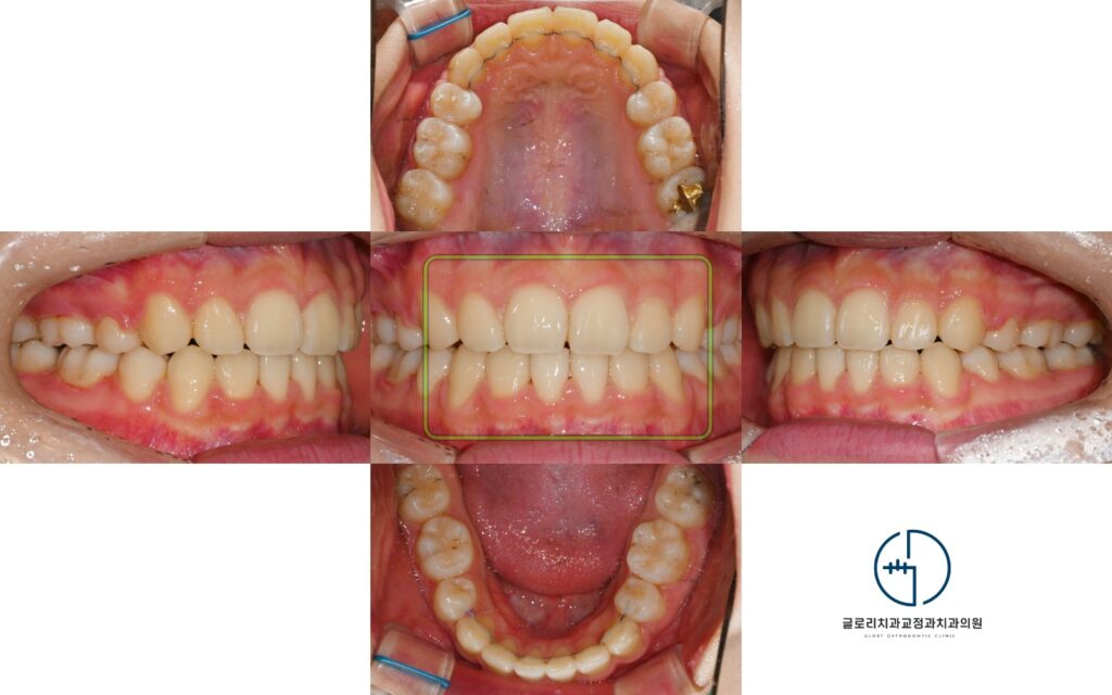 상봉역 치과 돌출된 입이 신경쓰여요: 발치교정으로 2급 부정교합 해결
