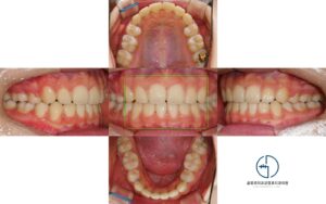 Read more about the article 상봉역 치과 돌출된 입이 신경쓰여요: 발치교정으로 2급 부정교합 해결