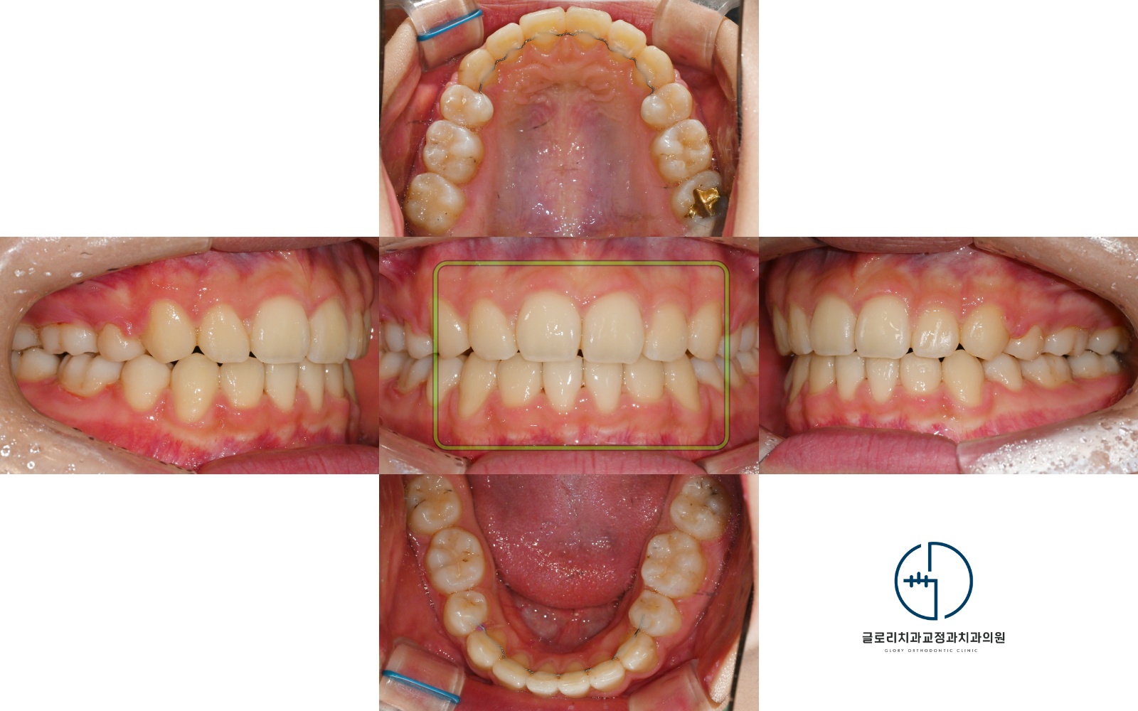 You are currently viewing 상봉역 치과 돌출된 입이 신경쓰여요: 발치교정으로 2급 부정교합 해결