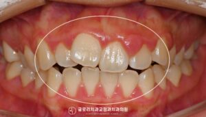 Read more about the article 망우동 치과 골격성 2급부정교합: 개방교합 비발치 교정으로도 개선가능할까?
