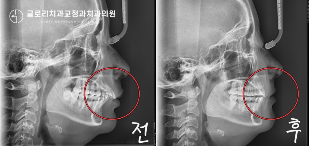 망우동 치과 치아 사이가 벌어지고 앞니가 튀어나와있어요. 골격성 2급 부정교합 개선 비발치 교정으로도 해결할 수 있을까