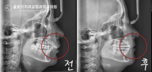 Read more about the article 망우동 치과 치아 사이가 벌어지고 앞니가 튀어나와있어요. 골격성 2급 부정교합 개선 비발치 교정으로도 해결할 수 있을까
