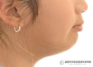 Read more about the article 상봉동 치과 성장기 골격성 2급 부정교합: 헤드기어와 바이오네이터를 활용한 1차교정