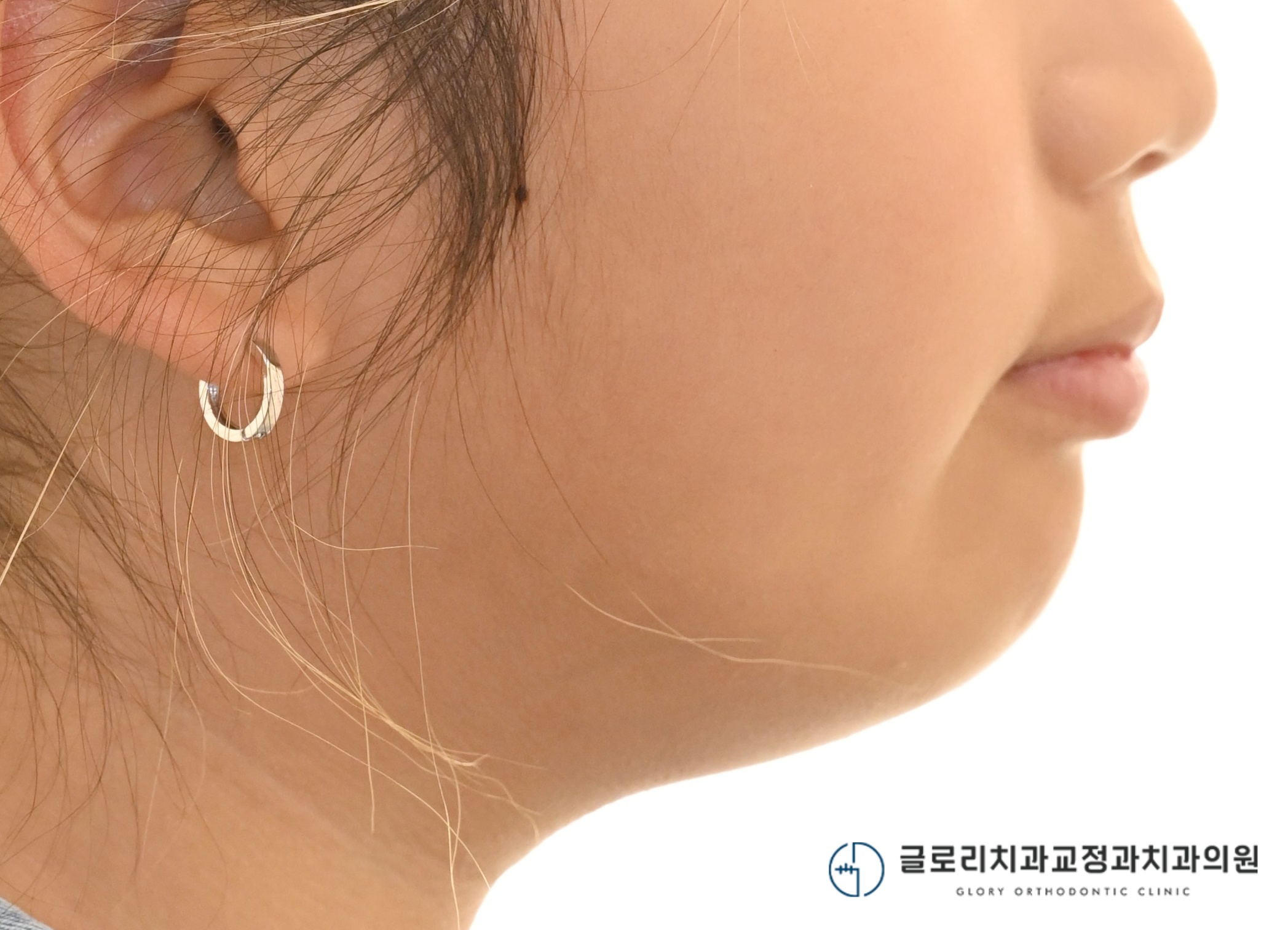 You are currently viewing 상봉동 치과 성장기 골격성 2급 부정교합: 헤드기어와 바이오네이터를 활용한 1차교정