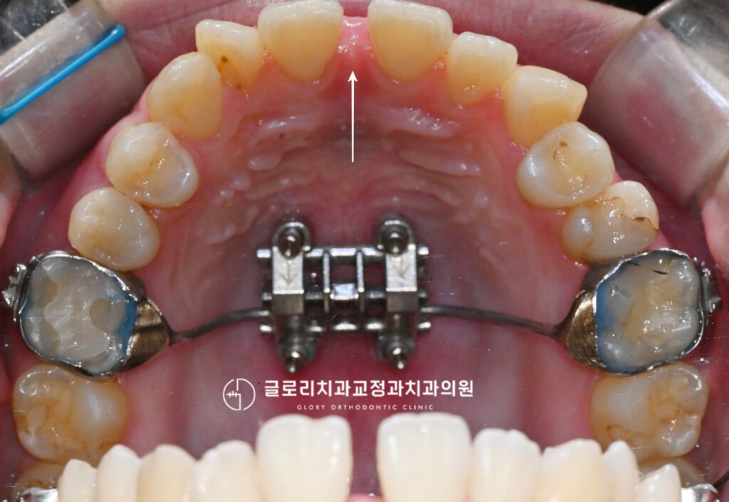 중랑구 교정치과 골격성 3급 부정교합, MARPE 상악 확장장치를 통한 개선