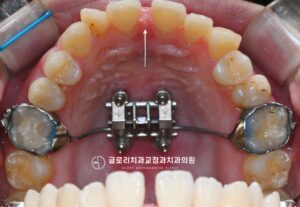 Read more about the article 중랑구 교정치과 골격성 3급 부정교합, MARPE 상악 확장장치를 통한 개선