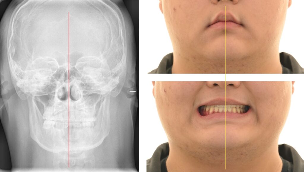 상봉동 치과, 안면부 비대칭을 동반한 반대교합 개선 사례, 상악골확장과 금속 장치 교정