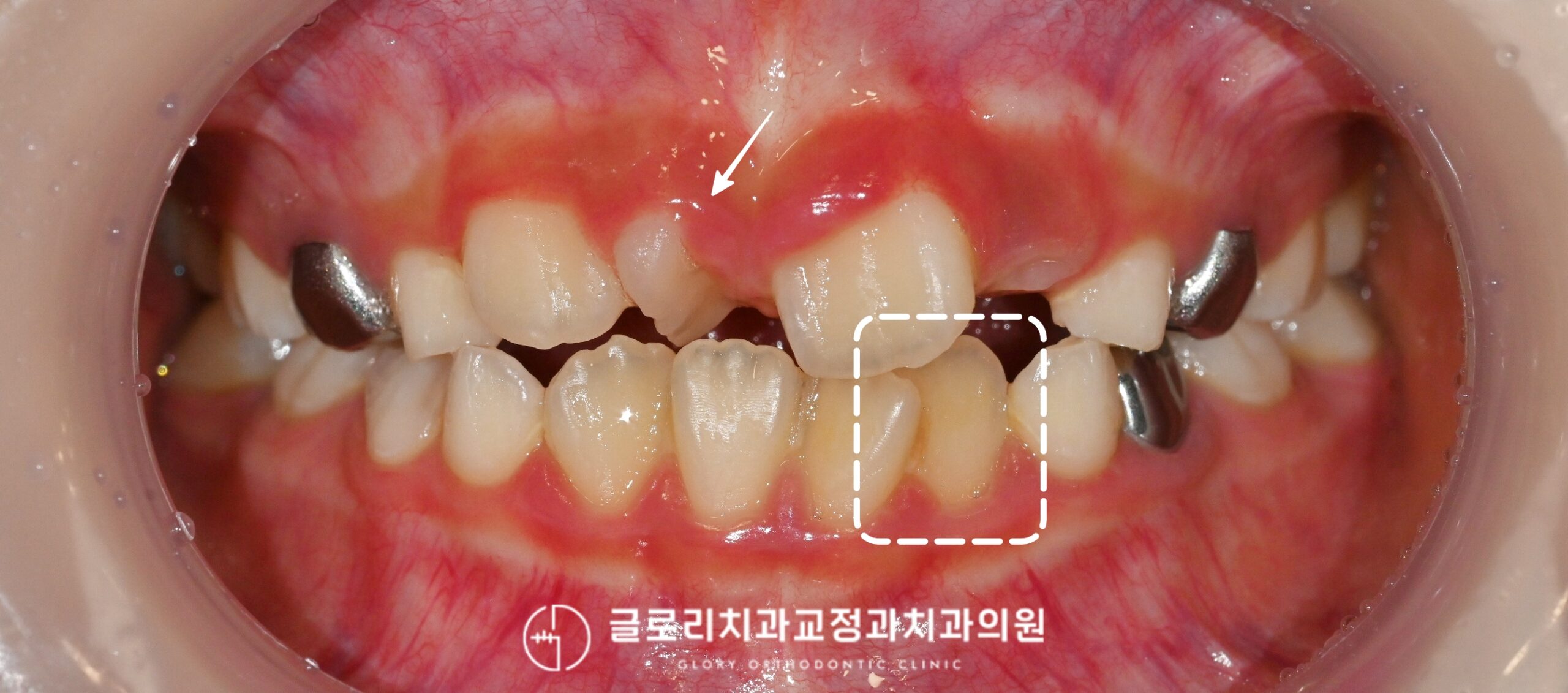 You are currently viewing 망우동 치과 성장기 소아의 인비절라인을 활용한 교정치료 알아보기