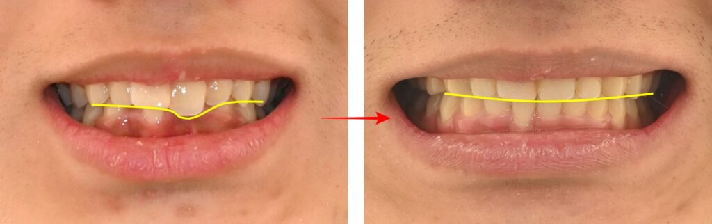 망우동 치과, 덧니와 좁은 치열을 비발치로 성장기에 맞춘 치료 계획을 세워 교정한 사례 알아보기