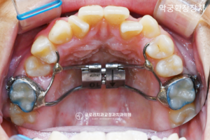Read more about the article 망우동 치과, 상악골확장장치를 활용하여 비발치 교정 과정