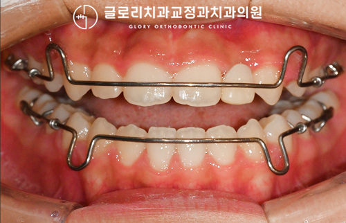 22번 측절치 결손과 반대교합! 교정 과정,+ 목동 치과