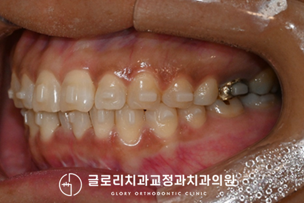 망우동 치과, 앞니 겹침과 정중선 틀어짐, 투명교정으로 개선한 치료 과정