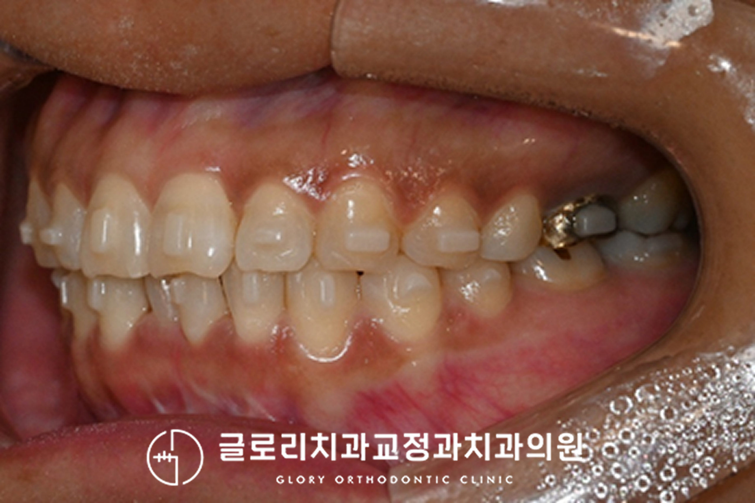 You are currently viewing 망우동 치과, 앞니 겹침과 정중선 틀어짐, 투명교정으로 개선한 치료 과정