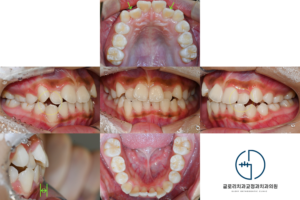 Read more about the article 상봉동 치과, 거꾸로 물리는 앞니와 삐뚤빼뚤한 치아, 인비절라인으로 티 안 나고 가지런하게! 약 2년