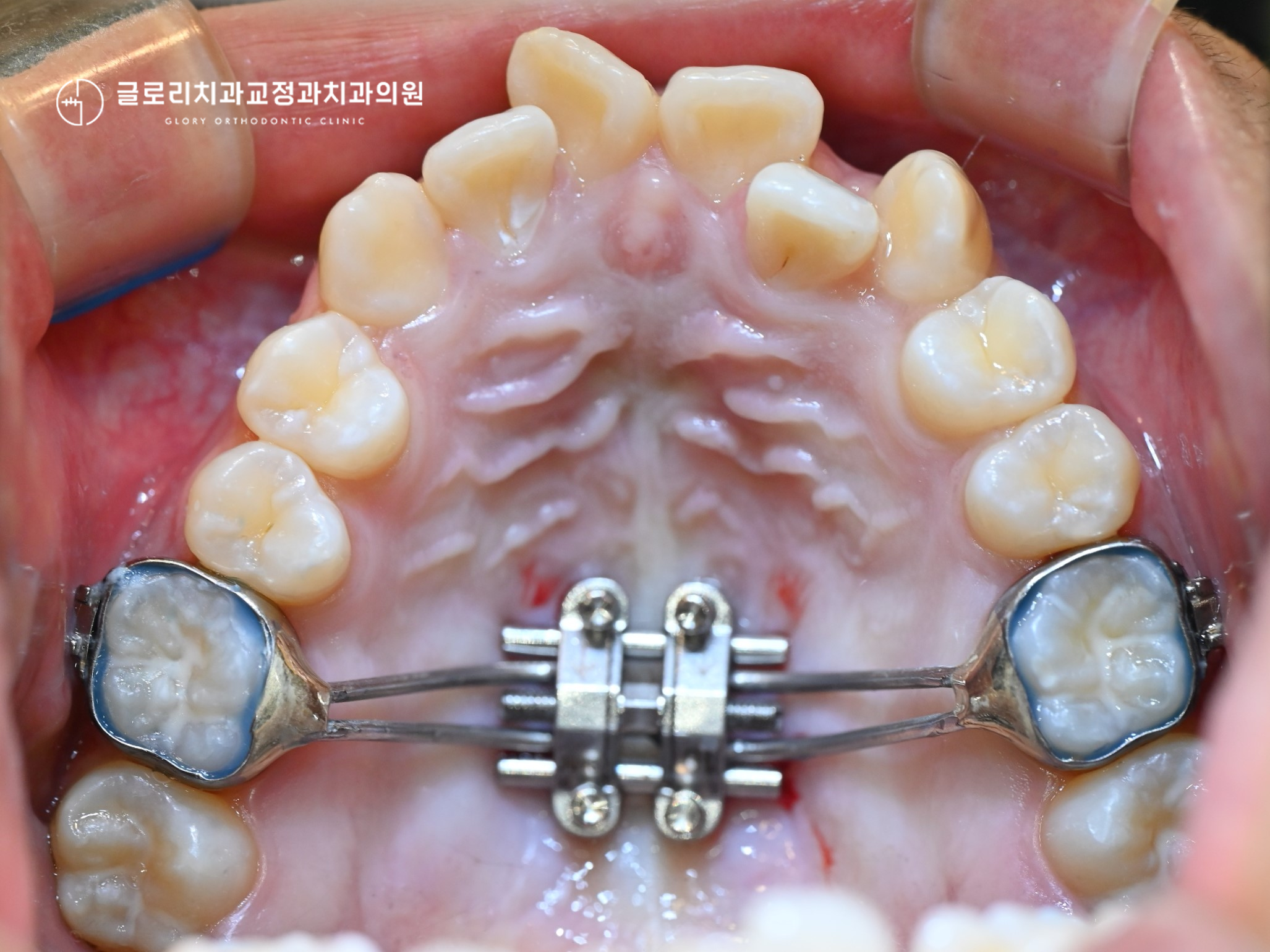 You are currently viewing 상봉역 치과와 알아보는 상악 악궁확장과 비발치 교정