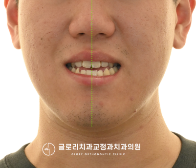 초진 구외 임상사진 — 정면·측면 안모
