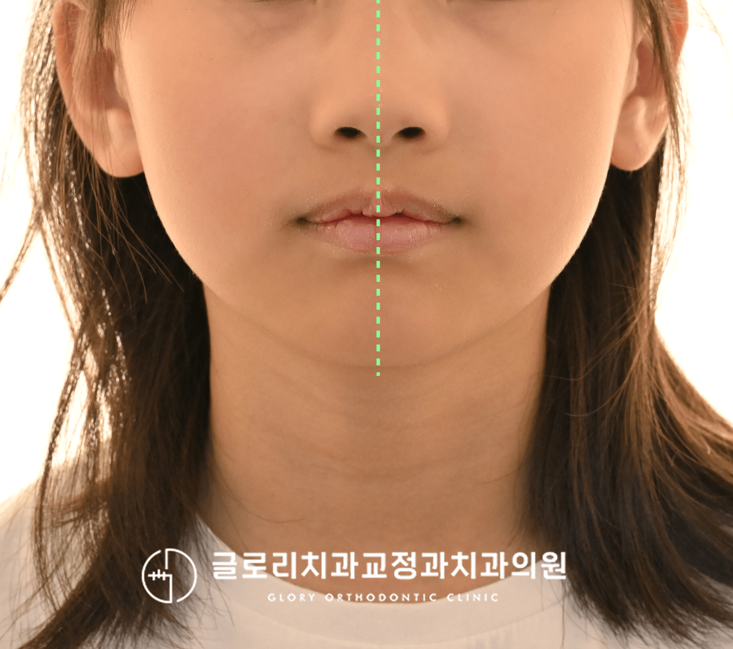 초진 구외 정면 클로즈업 — 정중선 표시