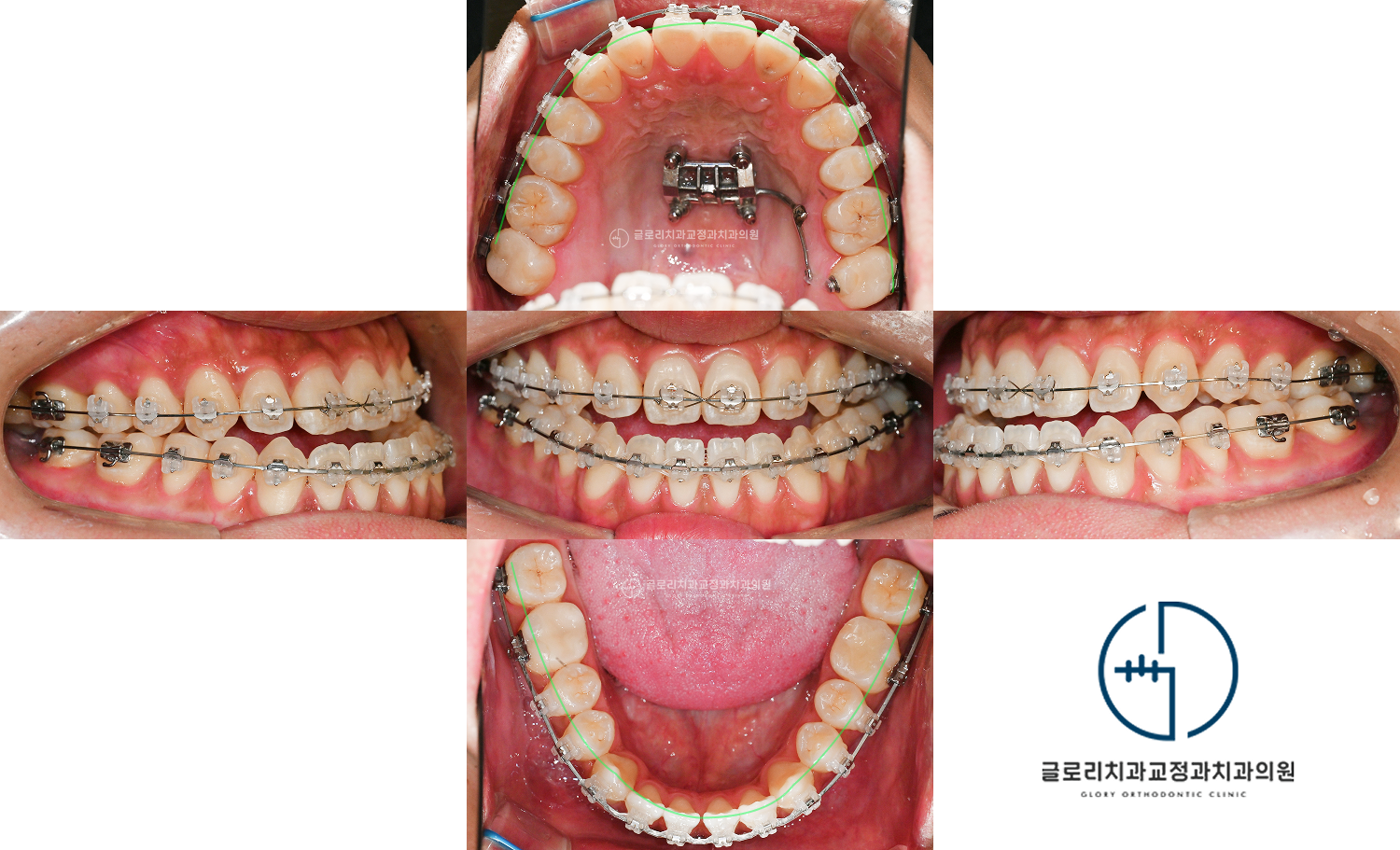 브라켓 장착 후 구내 5장 — 2025.03