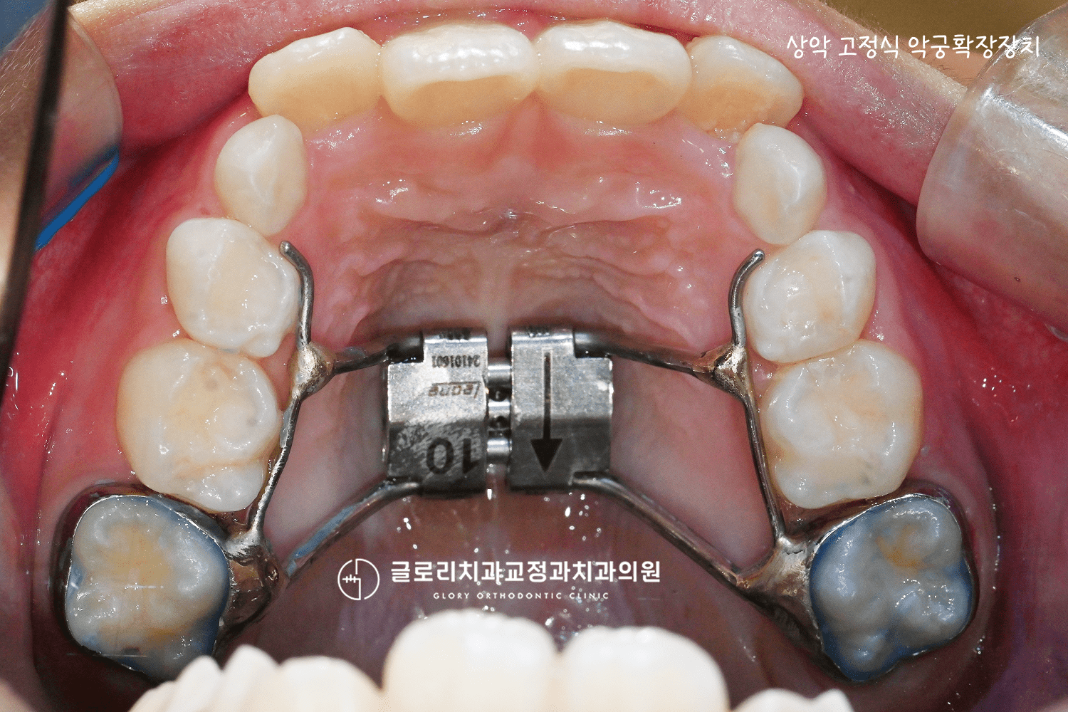 상악 고정식 악궁확장장치 장착
