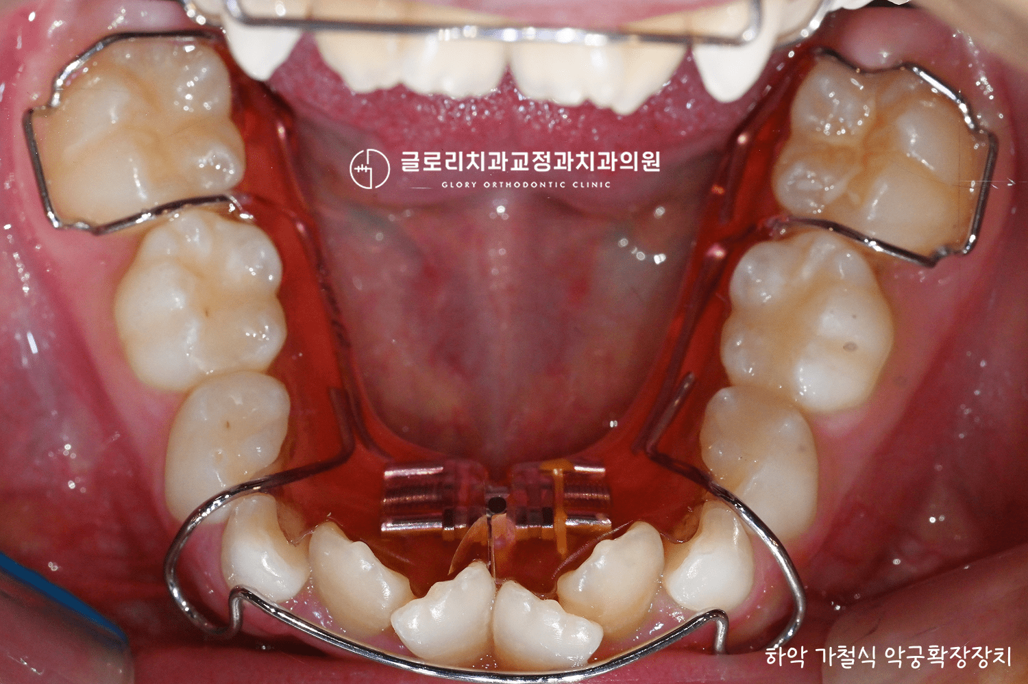 하악 가철식 악궁확장장치 장착