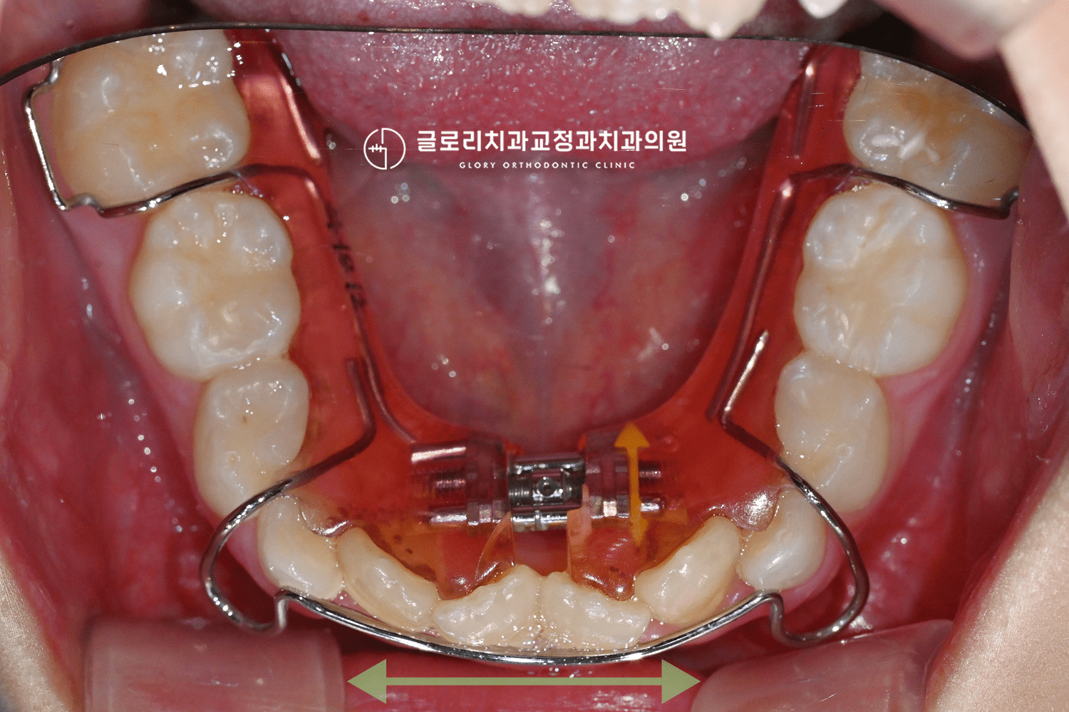 하악 확장장치 경과 — 스크류 활성화