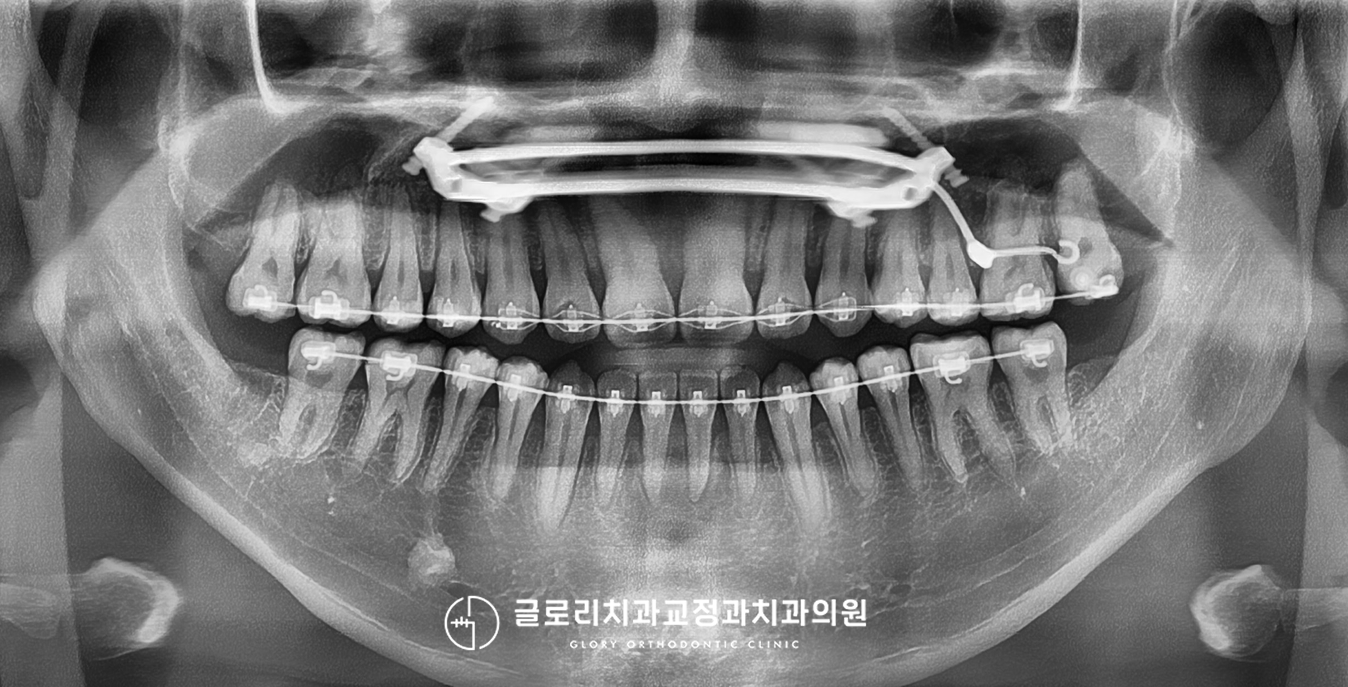 술전 교정 중 파노라마 — 2025.04