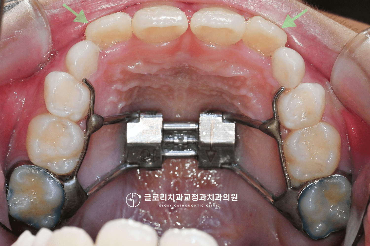 상악 확장장치 경과 — 치간 이개 확인