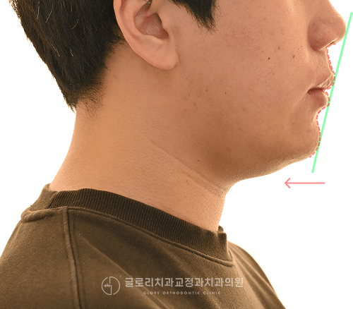 수술 직후 구외 임상사진 4컷 — 2025.07