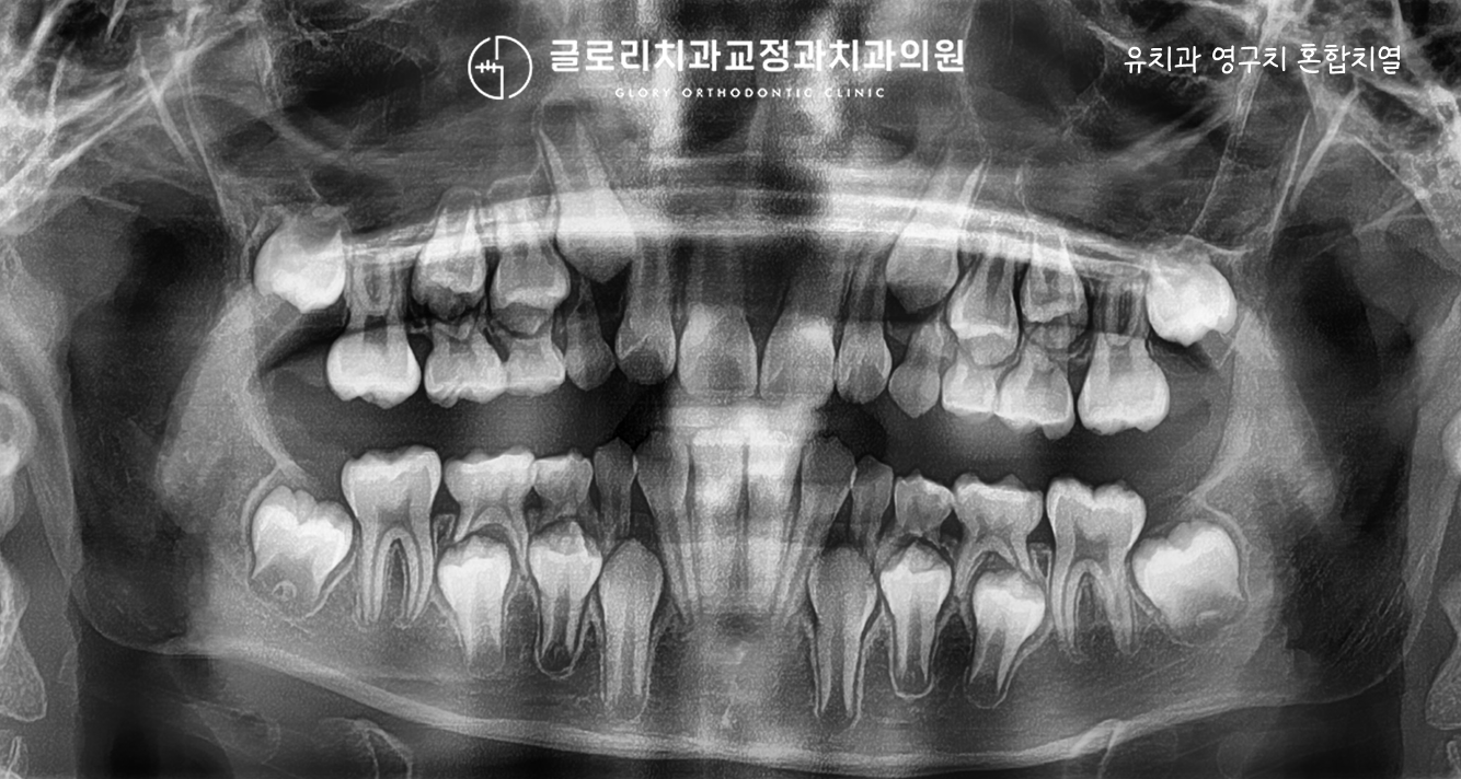 파노라마 — 혼합치열 상태