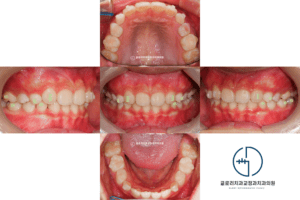 Read more about the article 2.상봉역치과, 혼합치열기 앞니가 삐뚤빼뚤하다면?(영구치 자리 확보)