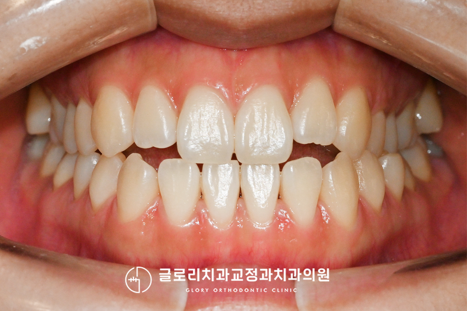 You are currently viewing 목동치과, 절단교합으로 불편한 식사 정밀한 교합 맞추기 과정 약 2년
