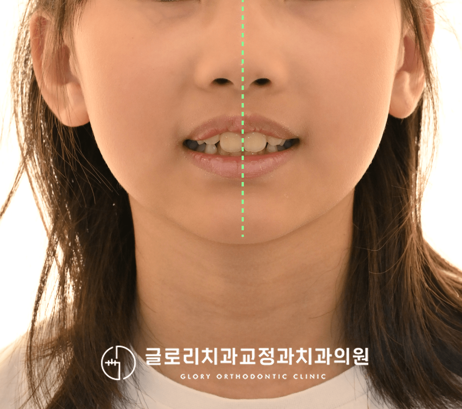 초진 구외 정면 클로즈업 — 교합 상태