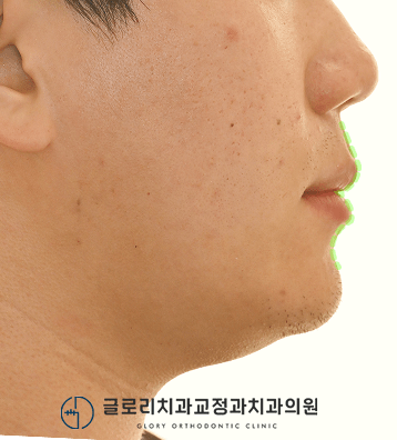 치료 완료 구외 임상사진 — 2026.06