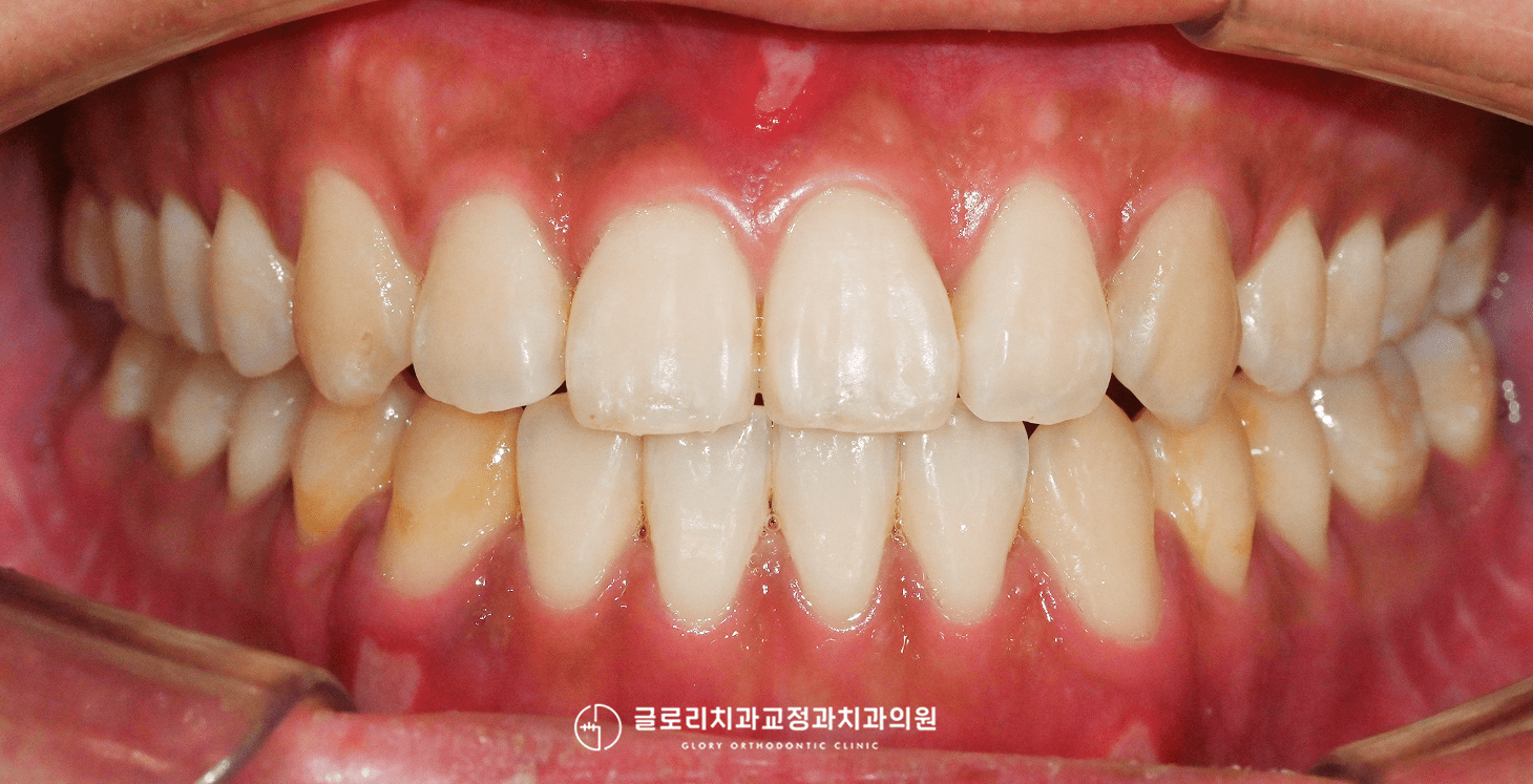 최종 교합 정면 클로즈업 — 2026.06.15