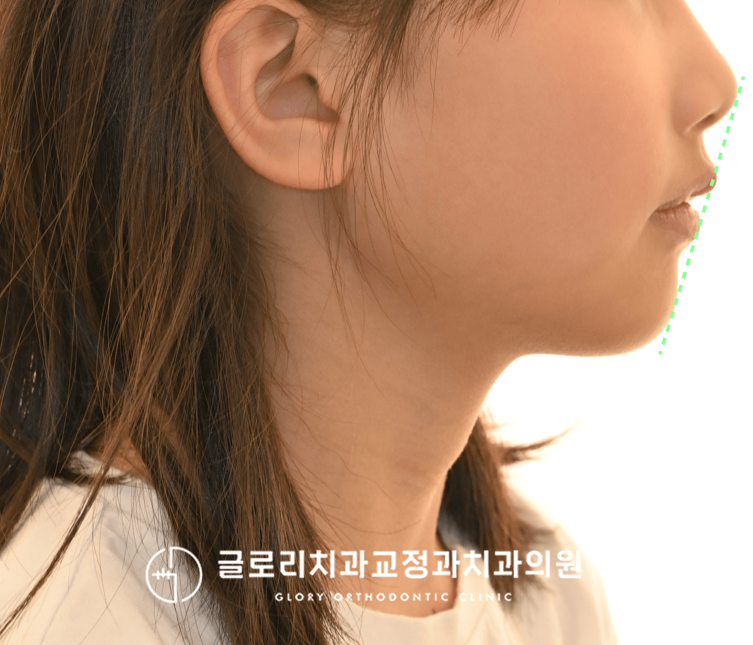 초진 측면 안모 — E-line 분석
