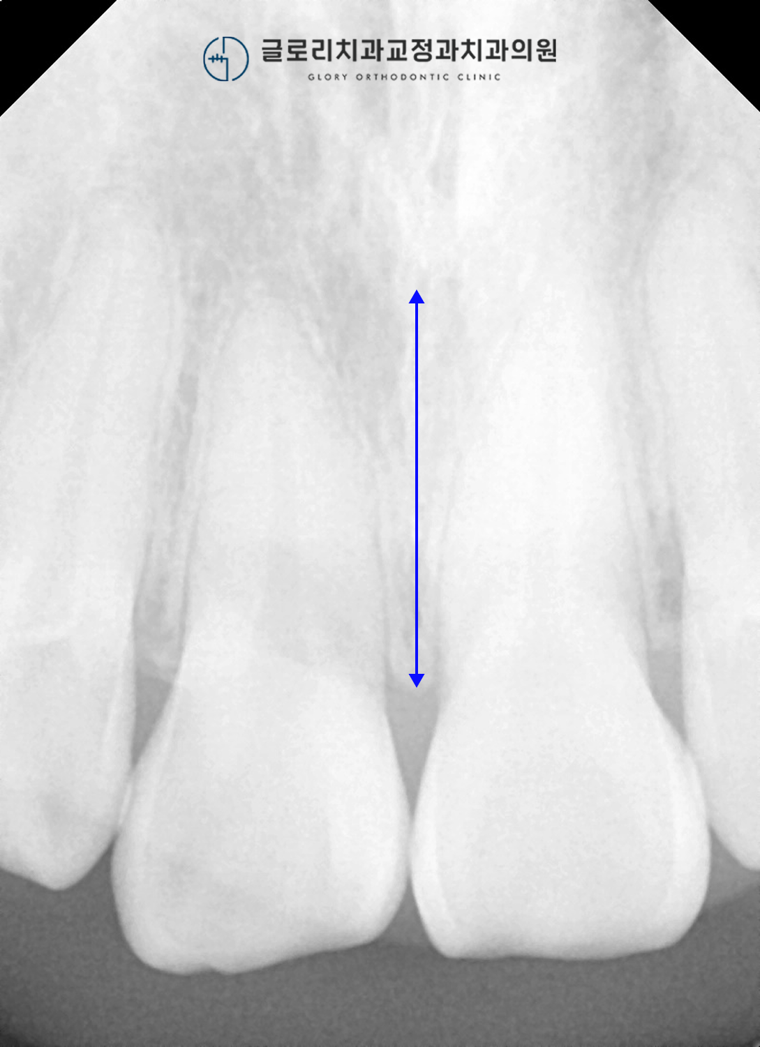 상악 중절치 치근단 X-ray
