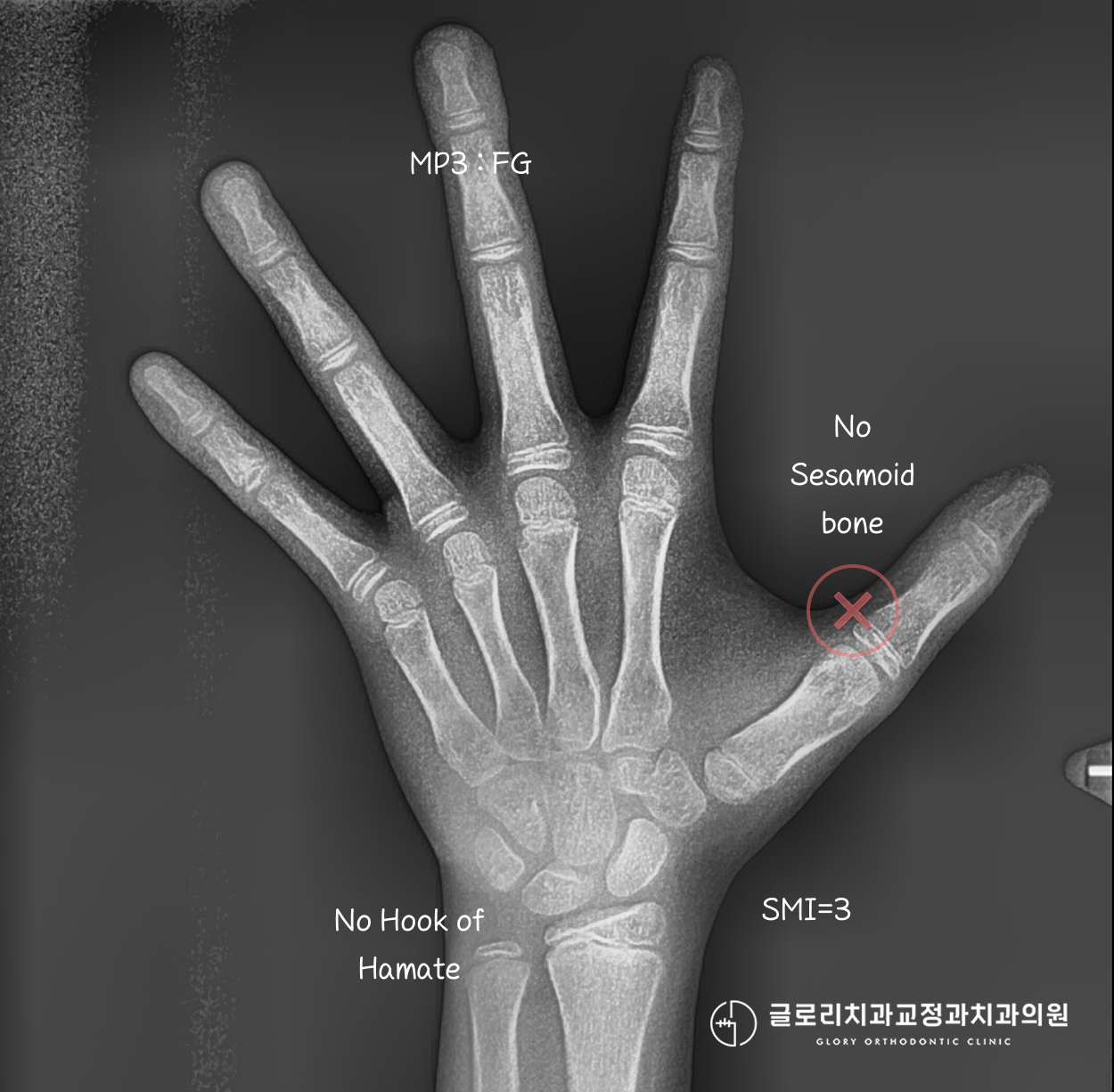 수완부 골연령 X-ray — SMI=3 표기