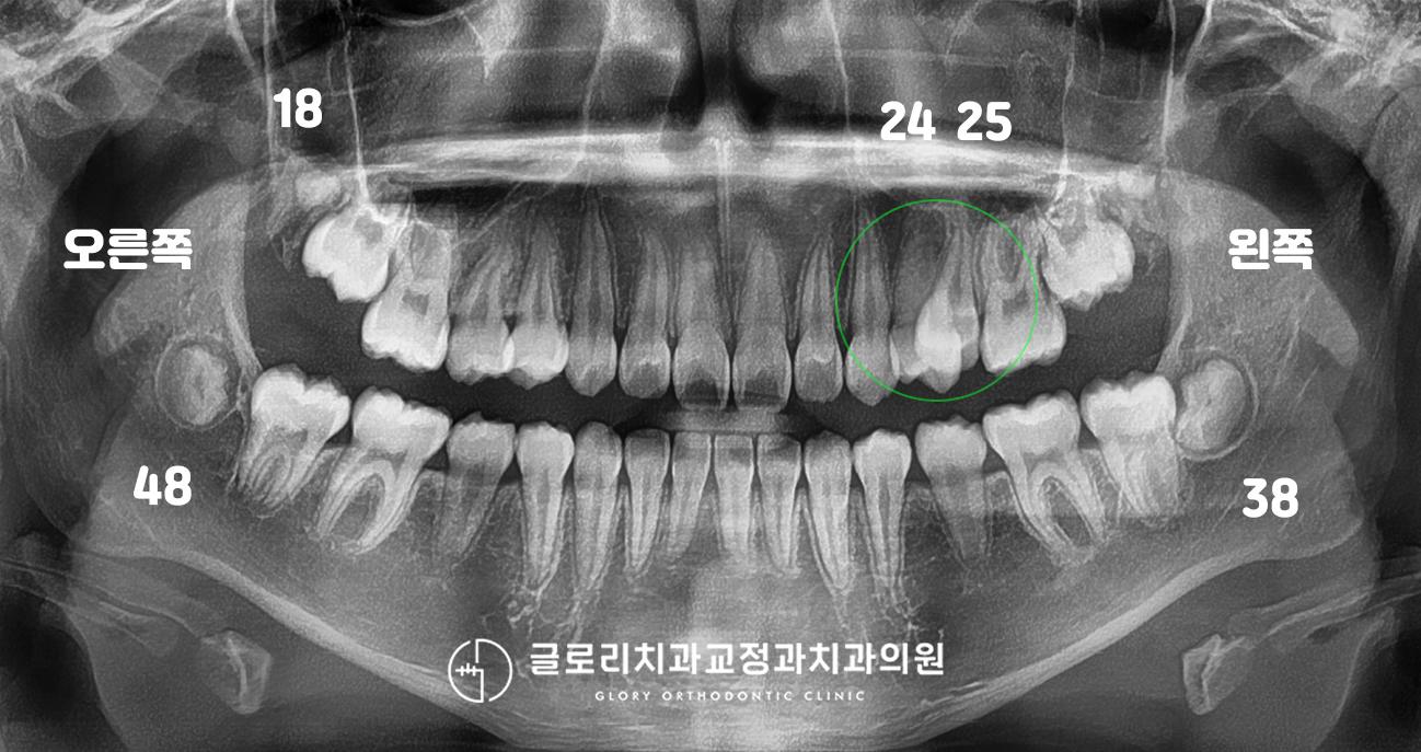 초진 파노라마 — 상악 좌측 소구치(24, 25번) 이소맹출, 사랑니 치배 4개 확인