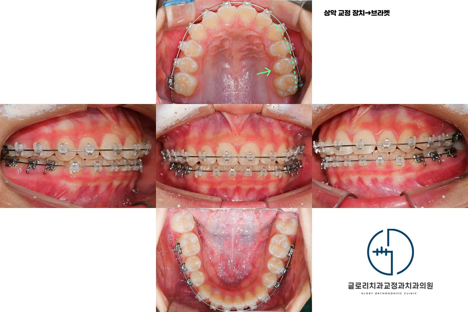 브라켓 교정 중간 경과 — 상악 좌측 소구치 치열궁 내 이동, 상악 교정장치 브라켓 전환
