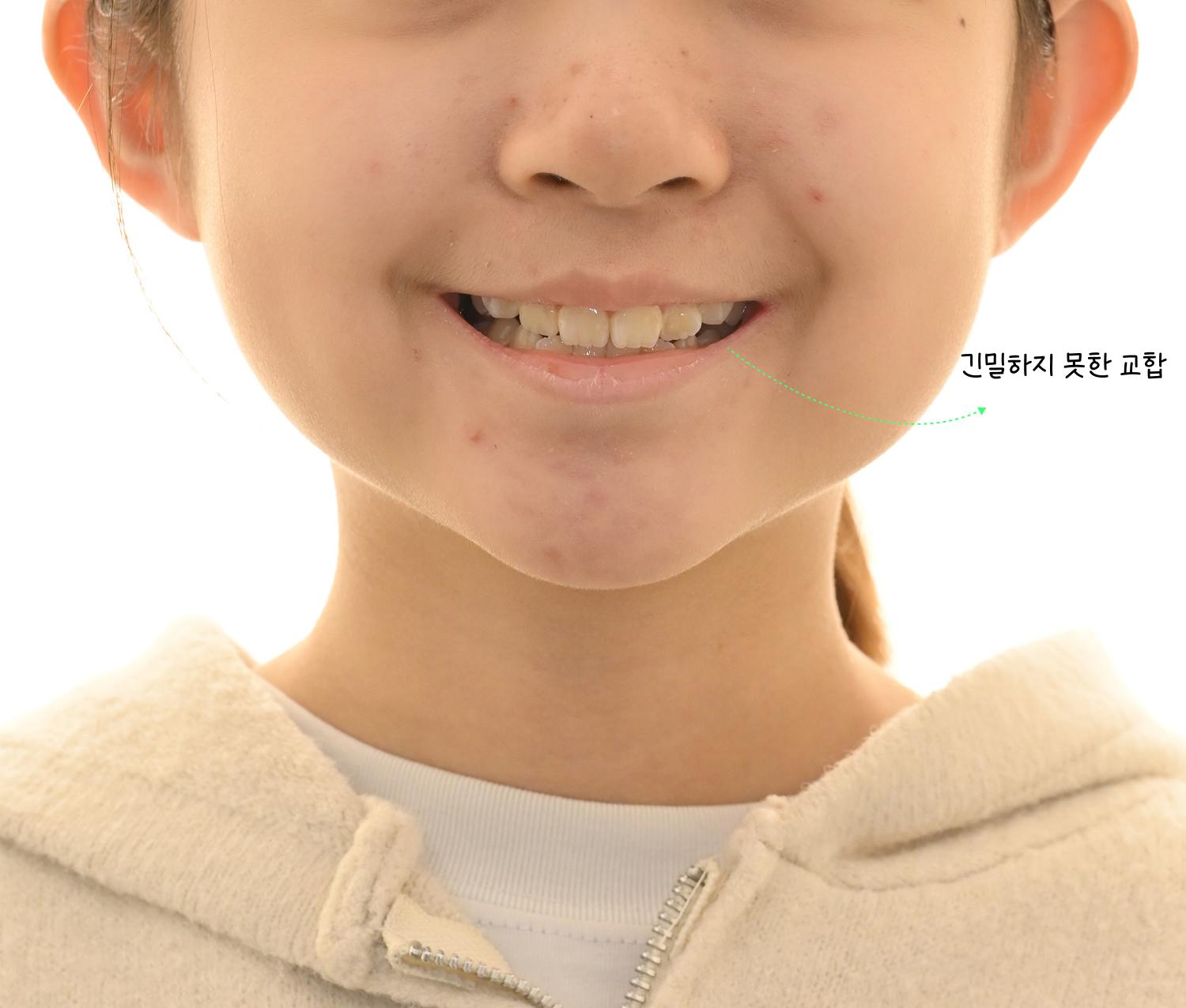 초진 정면 안모 — 긴밀하지 못한 교합 확인