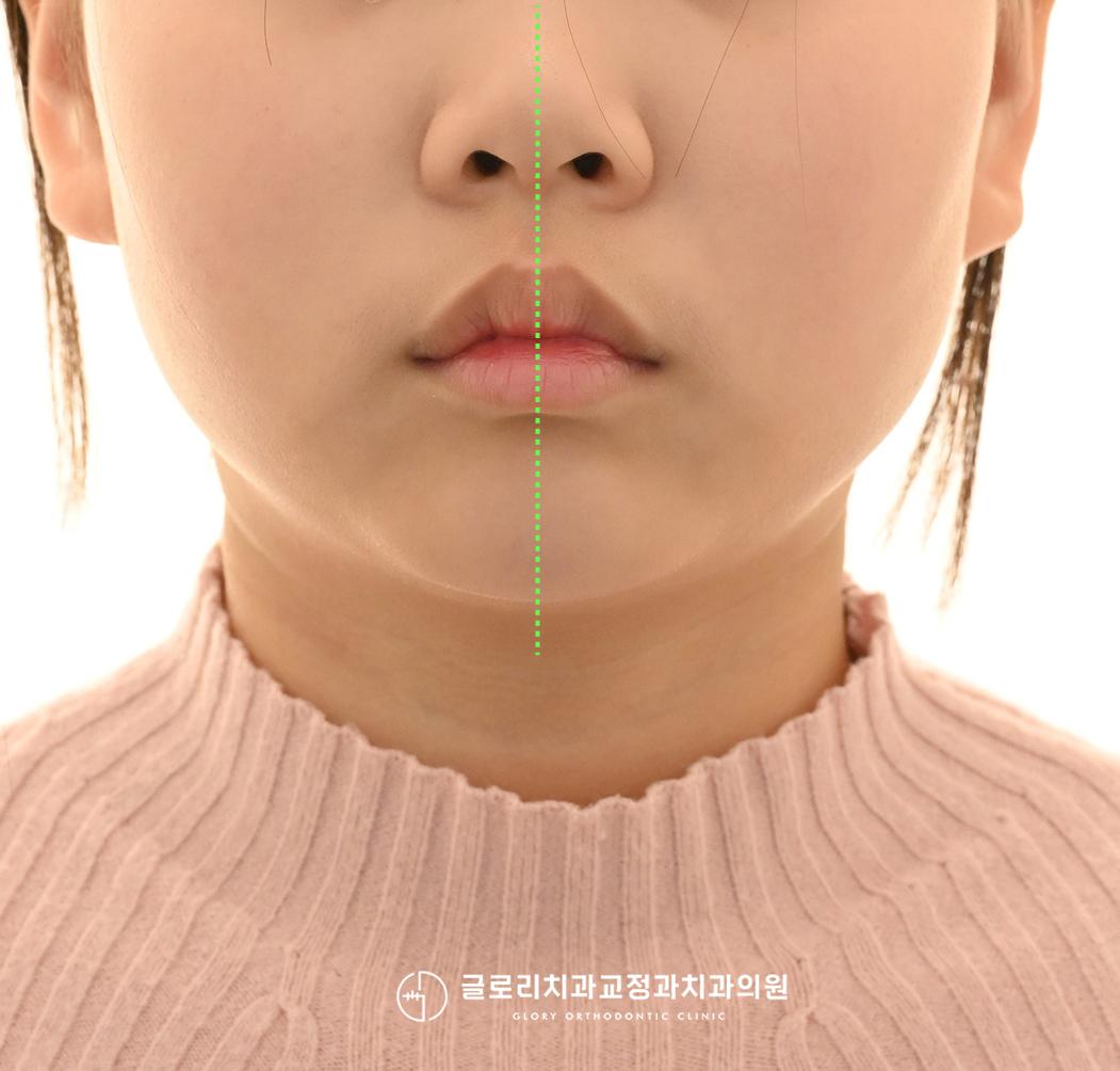 초진 구외 정면 클로즈업 — 정중선 확인