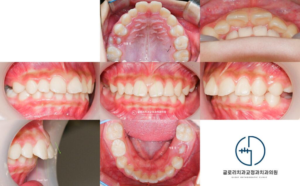 4. 혼합치열기 초기 검진에서 앞니 돌출과 과개교합이 관찰된다면? 상봉역 치과에서 설명드립니다.