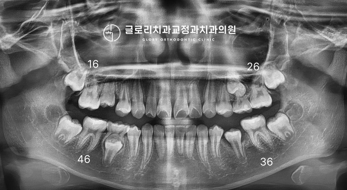 상봉역치과 초진 파노라마